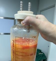 郯城水动力吸脂手术要做多久？
